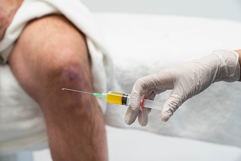 A man being treated with plasma-rich protein treatment